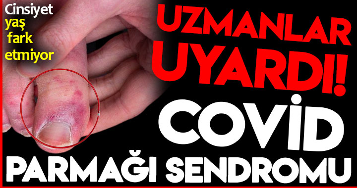 COVİD PARMAĞI SENDROMU!