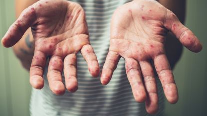 Kızamık hastalığı nedir? Kızamık hastası olursak ne yapmalıyız? işte cevapları..