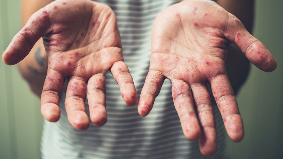 Kızamık hastalığı nedir? Kızamık hastası olursak ne yapmalıyız? işte cevapları..